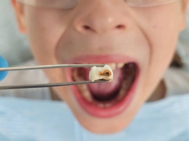 Best Emergency Dental Services for Seniors in Collinsville, AL